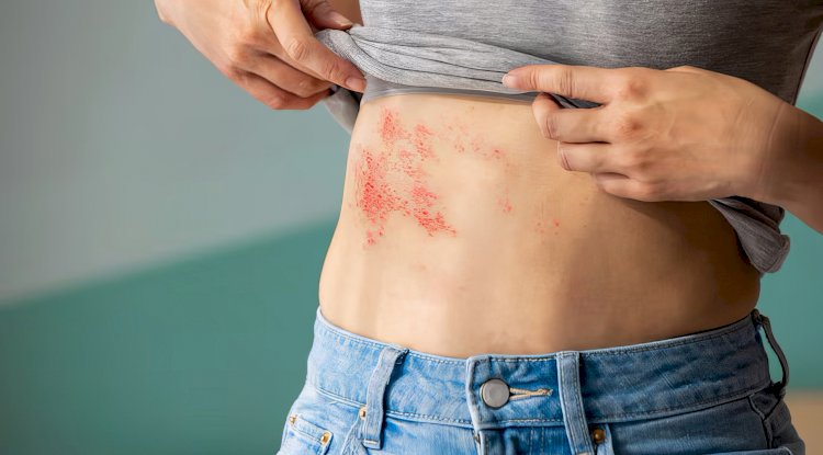 Brüksel ve Leuven Üniversite hastanelerinde hızlı dermatolog randevusu için ekstra ücret