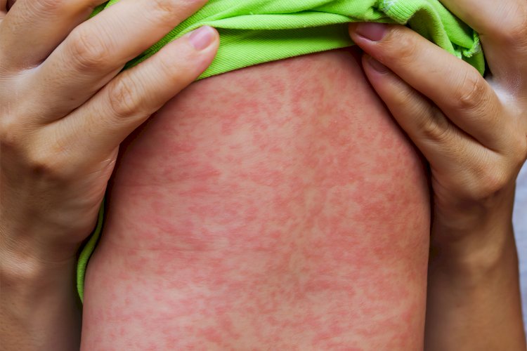 Limburg’da kızamık alarmı: Çoğu küçük çocuk olmak üzere 24 vaka